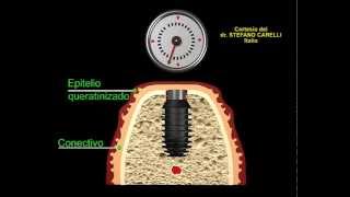 Implantes Bicon [upl. by Annairda]