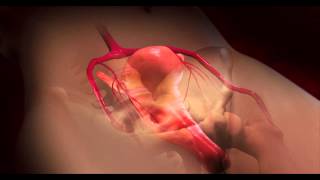 Dr Harris Narrates A 3D Animation of a Uterine Fibroid Embolization UFE [upl. by Schweitzer]