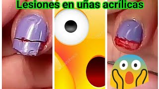 Lesiones en uñas acrílicas Primeros Auxilios en uñas acrílicas [upl. by Longawa360]