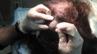 Pilar Cyst Removal on the Scalp [upl. by Eissoj]