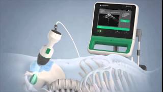 Verathon BladderScan Prime Portable Ultrasound Instrument [upl. by Marianne970]