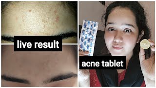 acne remove tablet live result  remove Dark spot in 7days  face wash for acne prone skin [upl. by Norahc]