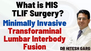 What is MIS TLIF Surgery Minimally Invasive Transforaminal Lumbar Interbody Fusion Dr Hitesh Garg [upl. by Becker553]