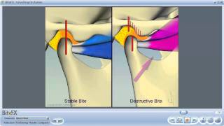 TMJ Disorders [upl. by Ojeitak]