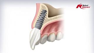 Angulated Screw Channel ASC Abutment [upl. by Ttegdirb428]