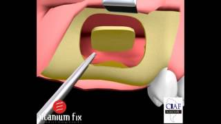 Levantamento de Seio Sinus Lift com Instalação de Implantes Imediatos [upl. by Tammie199]