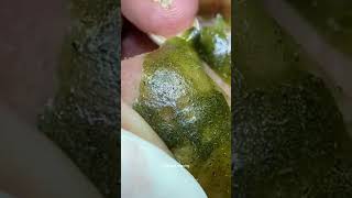 Blackheads Removal  Acne Treatment and Very Satisfying Satisfying Pimple pop blackheads [upl. by Anig948]