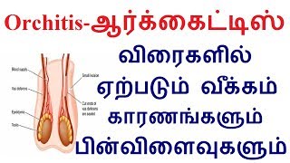 Orchitisஆர்க்கைட்டிஸ் விரைகளில் ஏற்படும் வீக்கம் காரணங்களும் பின்விளைவுகளும் [upl. by Hgielyk]