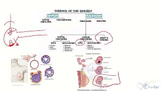 Pagets diseaseBreast tumors [upl. by Ylrac]