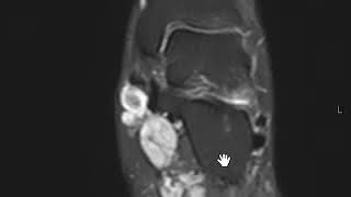 Plantar Fibromatosis [upl. by Enelime]