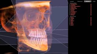 3D Cephalometric Analysis [upl. by Aihsemat]