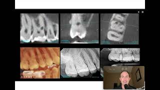 Endo for Internal Resorption 3 [upl. by Ylloh]