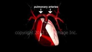 Saddle embolus pulmonary embolism video  Animation by Cal Shipley MD [upl. by Naivart835]