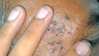 certifying relax sac dep spa face treatments 2023  skin cyst treatment 2023  sac dep spa New video [upl. by Ferriter]