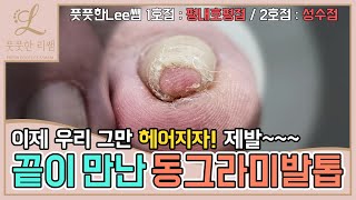 ENG SUB끝이 만난 동그라미발톱 이제 그만 헤어지자 ingrown toenail  ingrowing nail  Fresh Foot 풋풋한리쌤 성수점  평내호평점 [upl. by Atalayah]