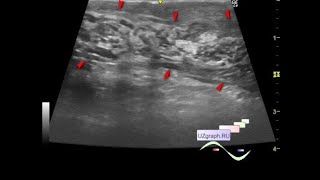 Pediatric Scrotal Ultrasound  Postoperative Funiculitis Epididymitis [upl. by Ressler]