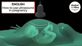 How to use ultrasound in pregnancy [upl. by Eskill448]