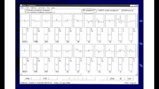 How to interpret Holter ECG [upl. by Liatnahs]