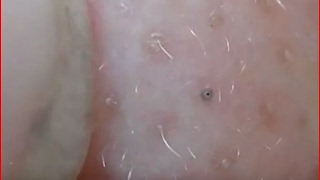 Very Black Blackheads removal [upl. by Placeeda450]