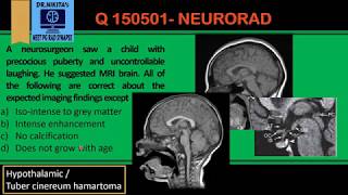 Hypothalamic hamartoma  Radsynapse [upl. by Hillery]