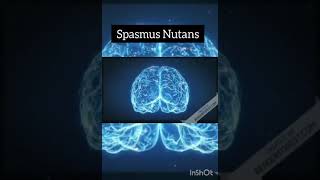 Spasmus Nutans [upl. by Kellene75]