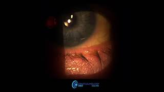 Watch implant of DURYSTA™ for patients with high eye pressure caused by glaucoma cases 1  4 [upl. by Tynan]