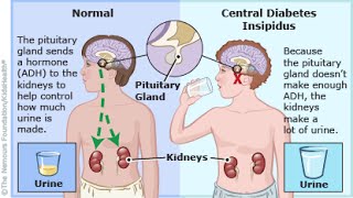 Central Diabetes Insipidus [upl. by Peltier]