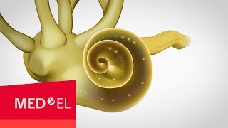 Sensorineural Hearing Loss Occurs in the Cochlea  MEDEL [upl. by Karol]