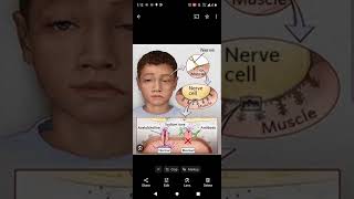 Myasthenia gravis causes symptoms pathology neuromuscular neetmedicos auto immune disorder [upl. by Cela]