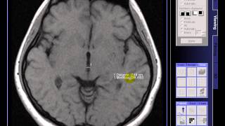 Brain MRI On case Widening cavum septum pelucidum [upl. by Ocirrej868]