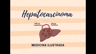 Hepatocarcinoma Introducción [upl. by Ocir]