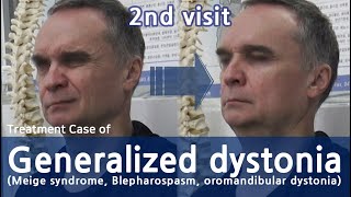 Generalized dystonia  Meige syndrome  Blepharospasm oromandibular dystonia  전신사경증 치료사례 [upl. by Wight]