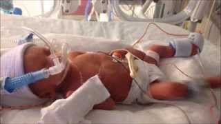 28 Week Preemie Sophias One Year Journey [upl. by Yeslek71]