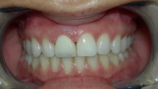 Cosmetic Dentist Recement Fallen Veneer [upl. by Menken]