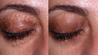 Unbelievable How I Remove All Milia By Lemon  White Bumps Under Eyes  Milia Treatment  Heath 365 [upl. by Mose24]