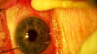 Durysta Glaucoma Implant [upl. by Bred]