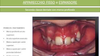 Apparecchio fisso e Espansore Prima e Dopo [upl. by Kinsley247]