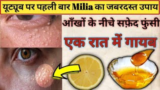 7 Days Challenge 😍 GET RID OF TINY BUMPS NATURALLY AT HOME  Milia Home Remedies  Milia Removal [upl. by Adnarym926]