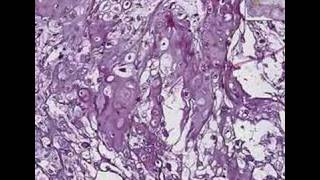 Histopathology BoneChondroma [upl. by Beverley]