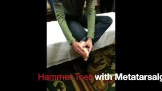 Hammer Toes Non Surgical Correction [upl. by Tamiko]