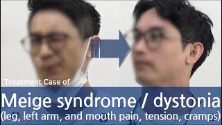 Meige syndrome  Dystonia facial oromandibular eyes tongue neck half of body  디스토니아 치료사례 [upl. by Iramaj]