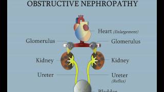 Posterior Urethral Valves  Obstructive Nephropathy [upl. by Airlia544]