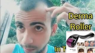 How Many Times use Derma Roller  Derma Roller Hair Regrowth  Microneedle At Home [upl. by Nazus]