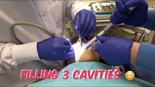 FILLING 3 CAVITIES [upl. by Buffum]