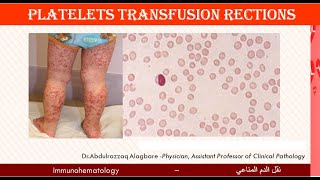 Lecture 218 Platelets Transfusion Reactions [upl. by Ignacius186]