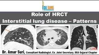 HRCT chest in interstitial lung disease  Chest radiography basics  Classification amp patterns [upl. by Fennie945]