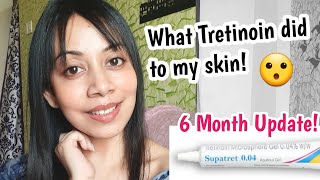 Tretinoin cream Before and After 6 Month update Supatret Tretinoin microsphere gel 004 ww [upl. by Enier]