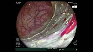 Mistakes in endoscopic resection and how to avoid them [upl. by Goddord]