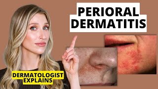 Dermatologist Explains Perioral Dermatitis What it Looks Like Causes amp Treatments  Dr Sam Ellis [upl. by Hackney]