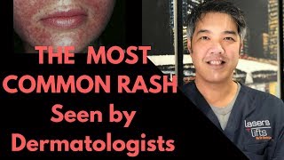 How to treat Perioral Dermatitis Dermatologist Explains [upl. by Ahsilak864]